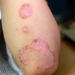 tratament psoriazis
