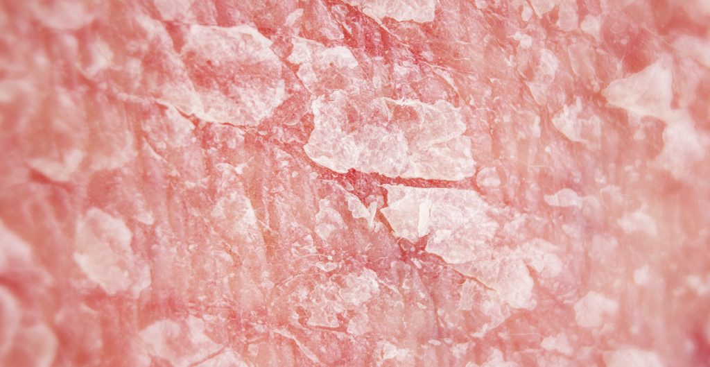 diferenta-psoriazis-lupus