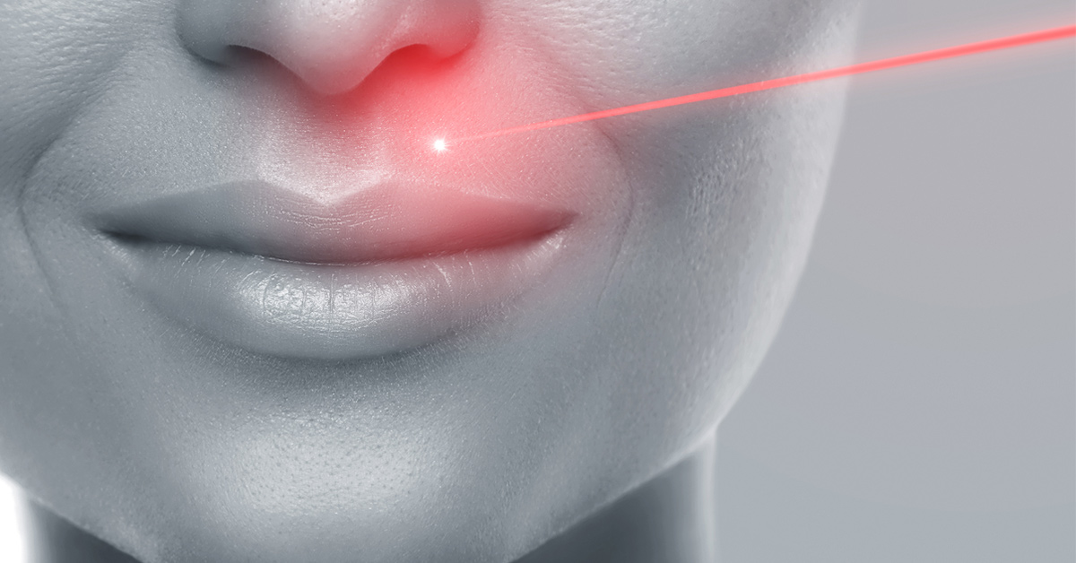 laser-ablativ