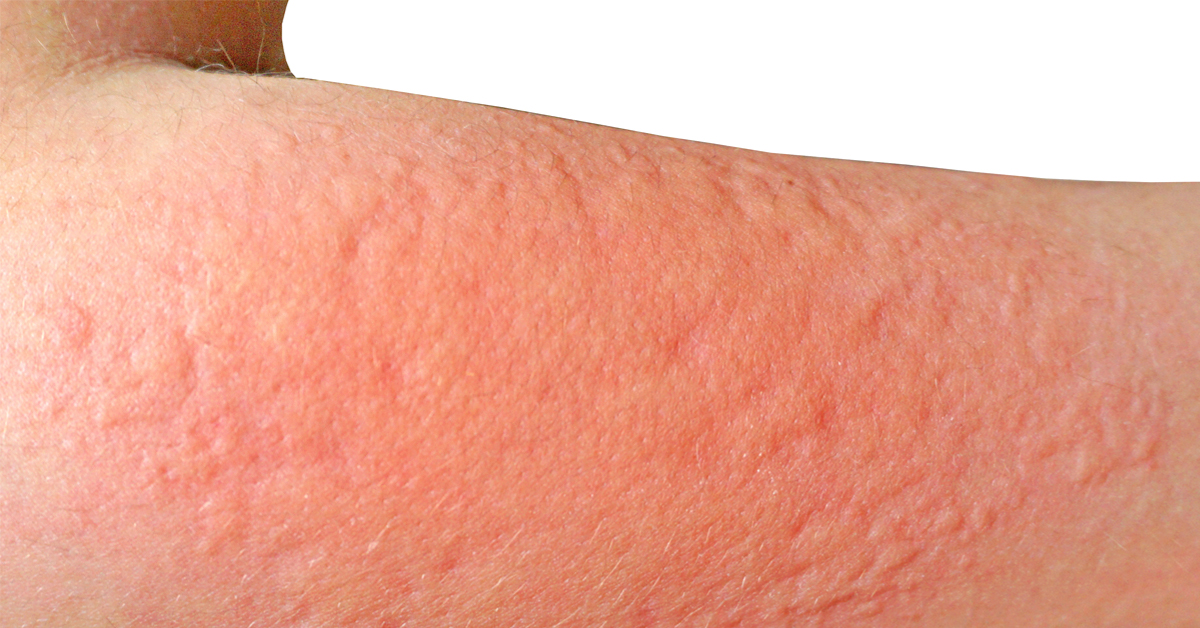 dermatita herpetiforma